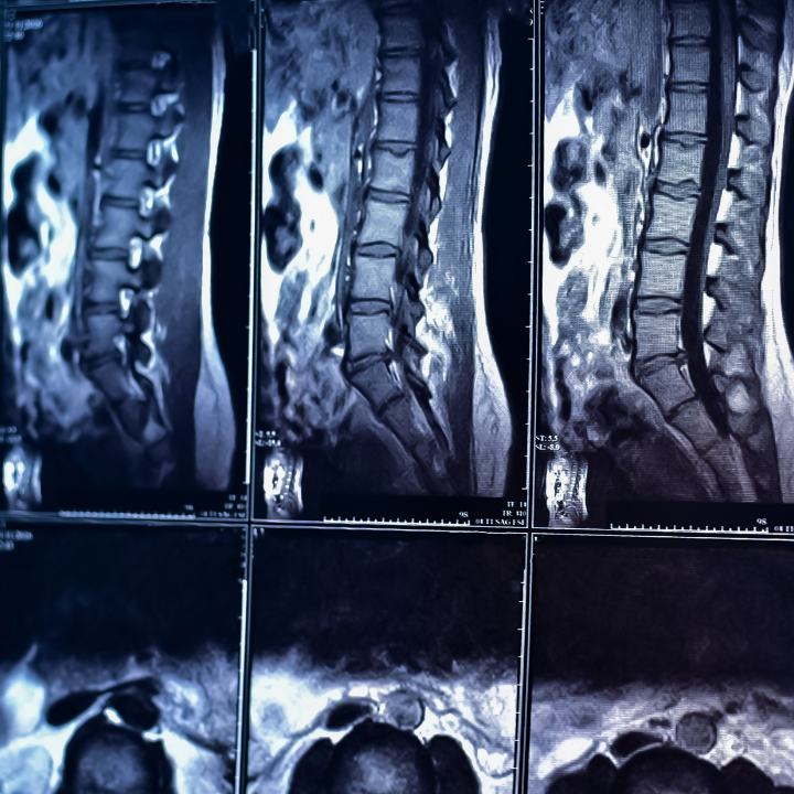 Featured image for “Understanding Compensation for Spinal Injuries”